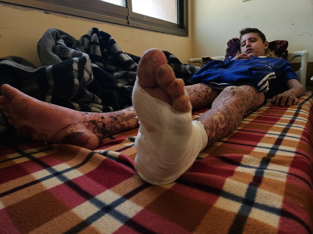 nadir cilt hastasi gazzeli cocuk saldirilar nedeni ile tedavi olamiyor 1 65DFZqMT