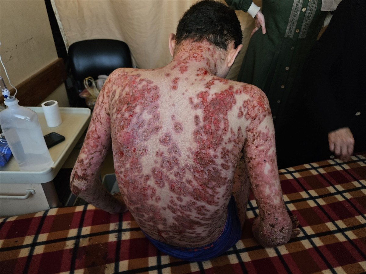 nadir cilt hastasi gazzeli cocuk saldirilar nedeni ile tedavi olamiyor 12 ZLAIqFrl