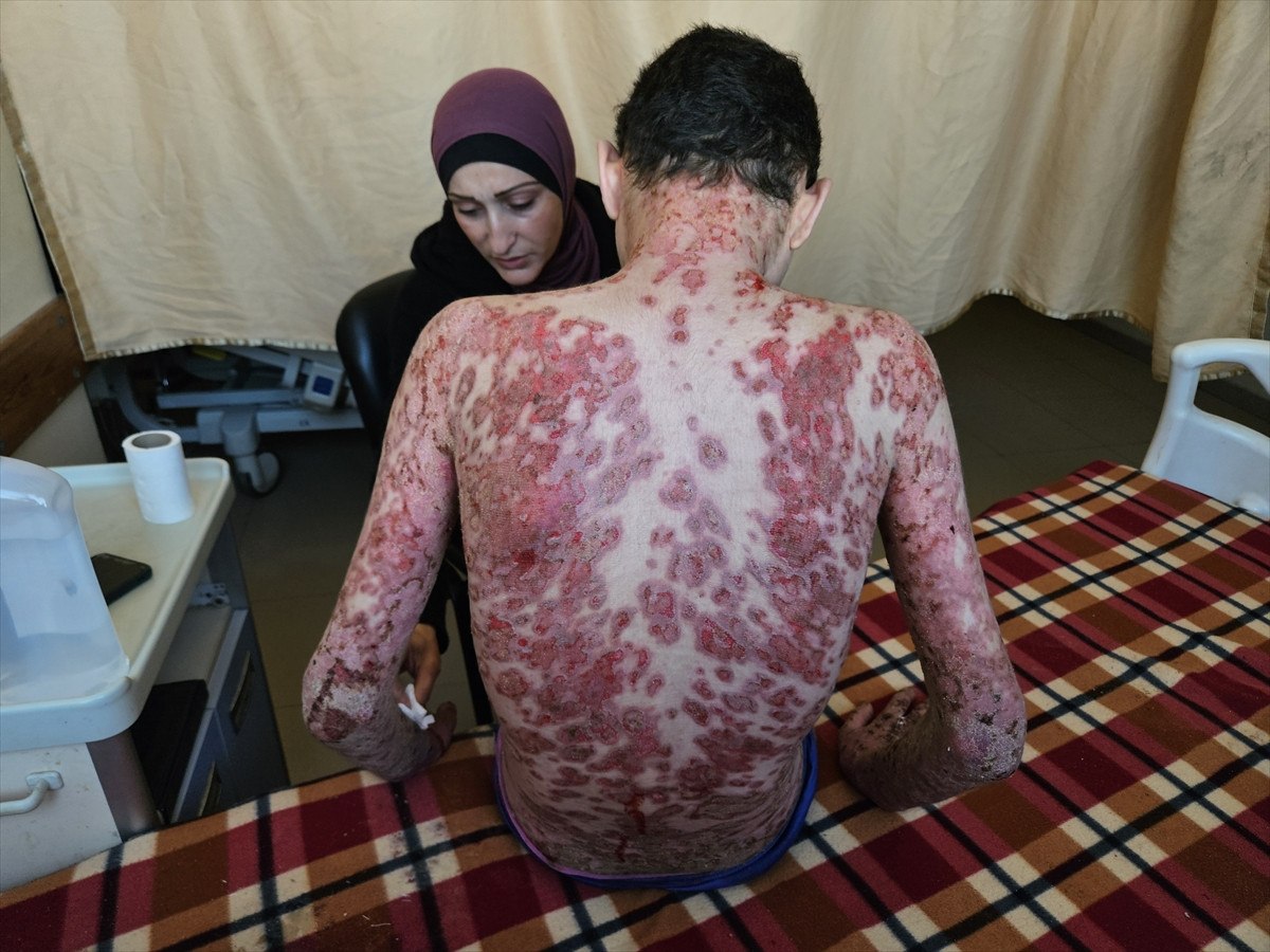nadir cilt hastasi gazzeli cocuk saldirilar nedeni ile tedavi olamiyor 14 AzDEh98B