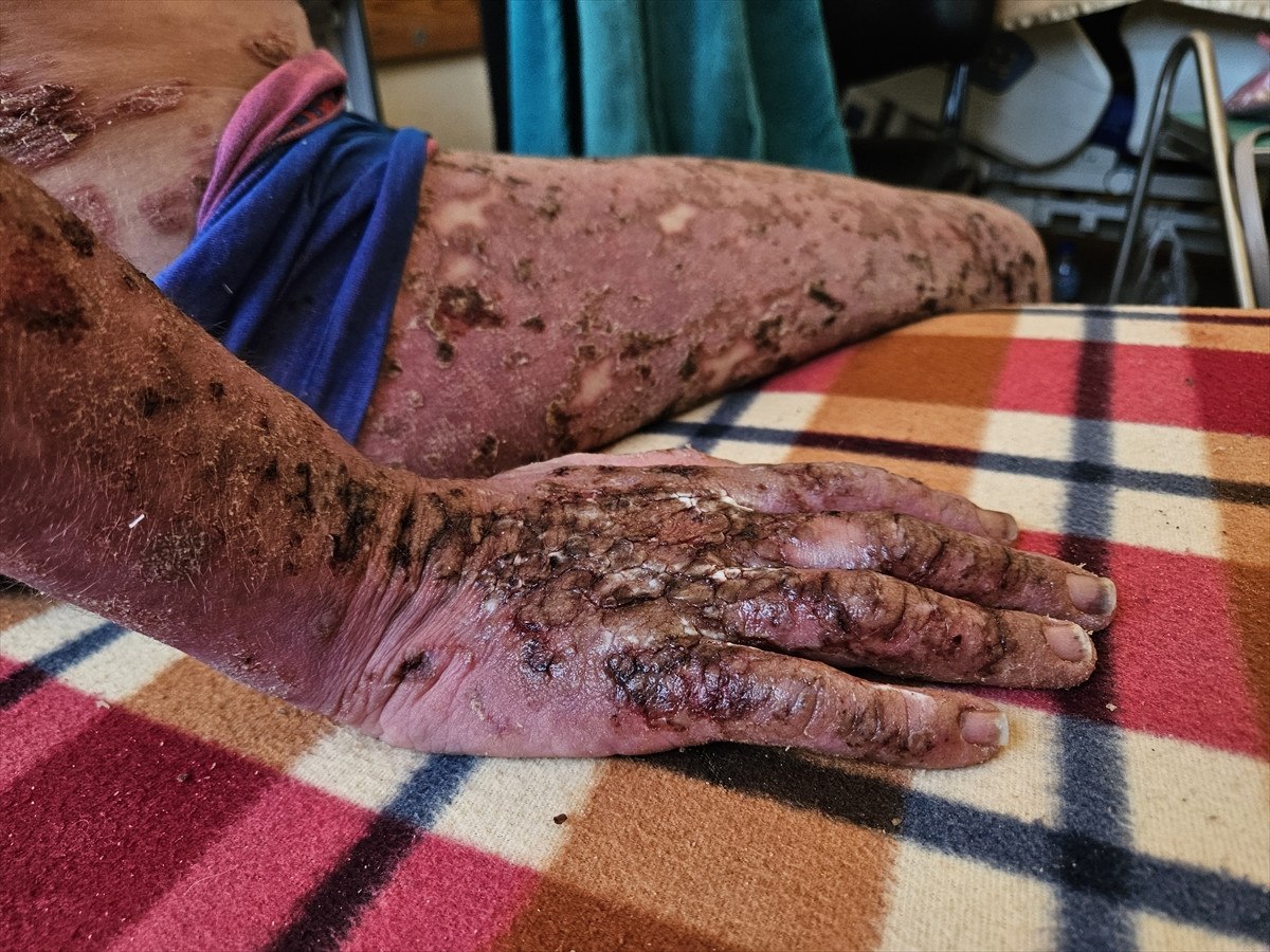 nadir cilt hastasi gazzeli cocuk saldirilar nedeni ile tedavi olamiyor 15 dKIfdYFk