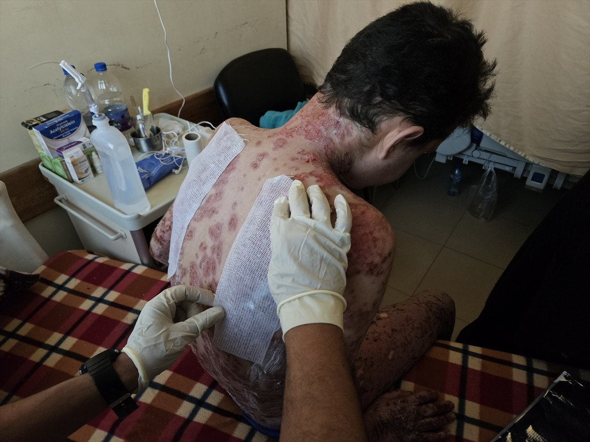 nadir cilt hastasi gazzeli cocuk saldirilar nedeni ile tedavi olamiyor 19 uwHDQ1Op