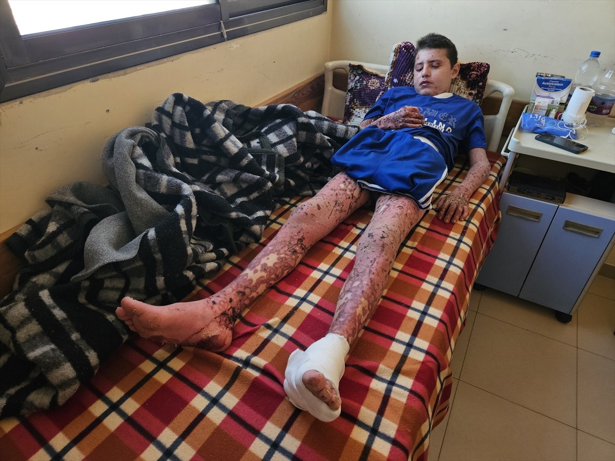 nadir cilt hastasi gazzeli cocuk saldirilar nedeni ile tedavi olamiyor 2 wSKyZQw3