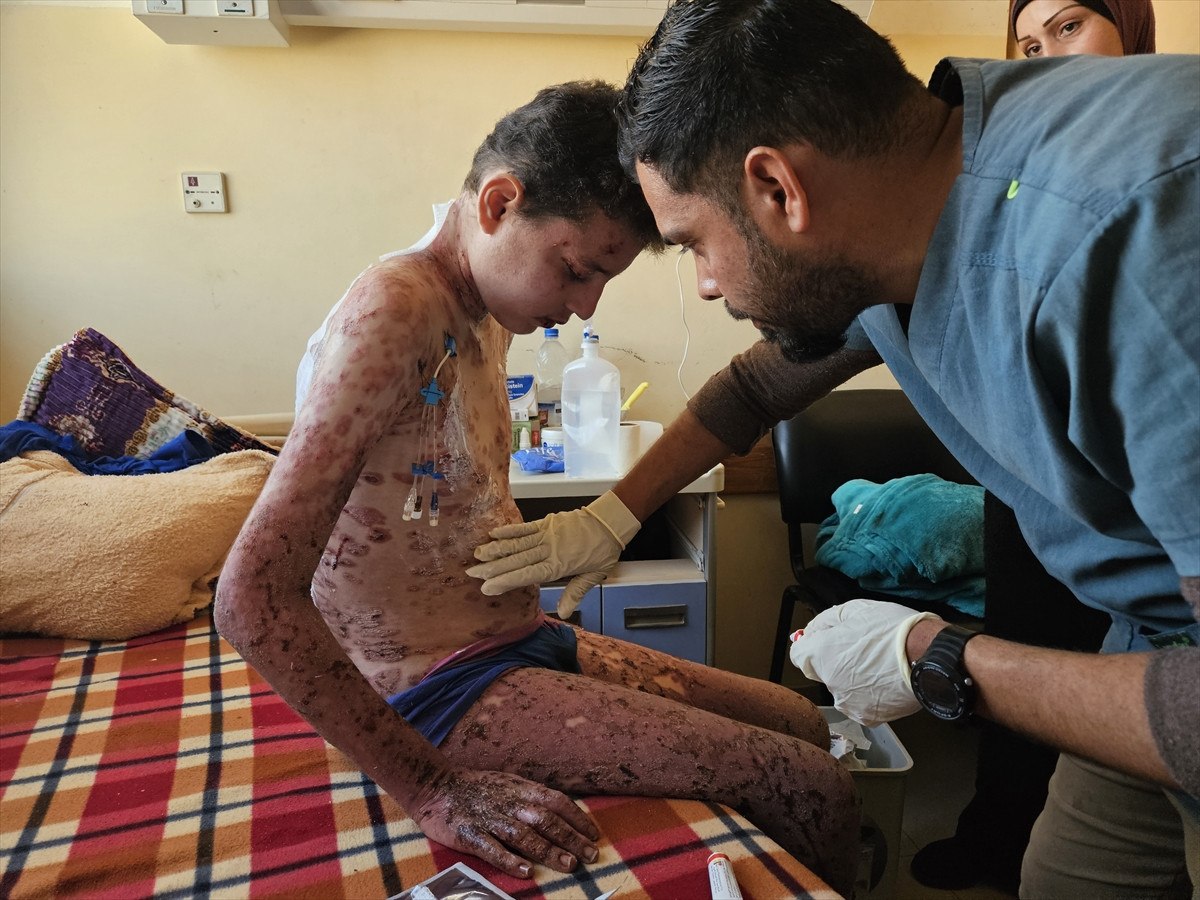 nadir cilt hastasi gazzeli cocuk saldirilar nedeni ile tedavi olamiyor 20 mc6zdPvi