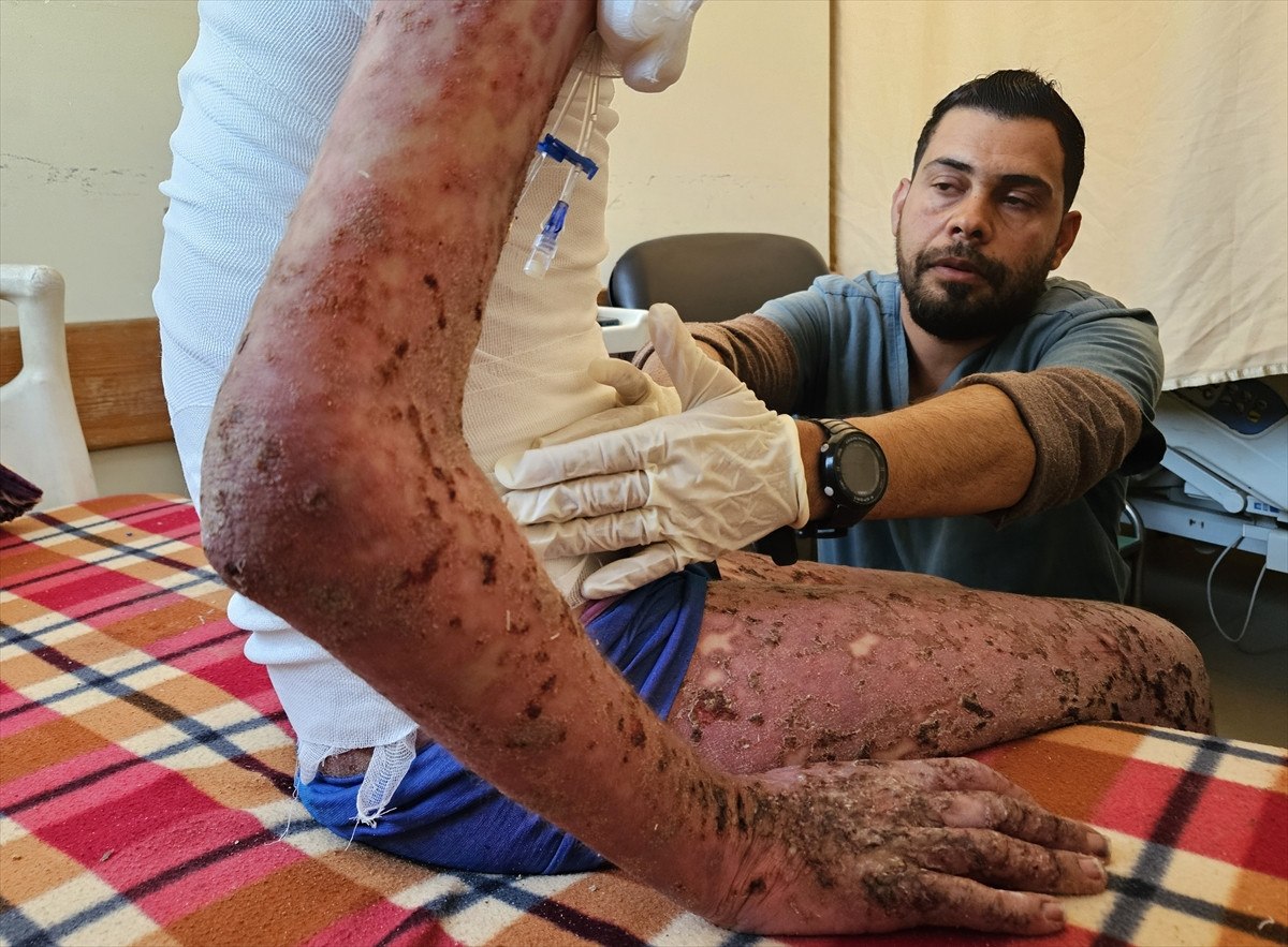 nadir cilt hastasi gazzeli cocuk saldirilar nedeni ile tedavi olamiyor 22 lvsEzK6H