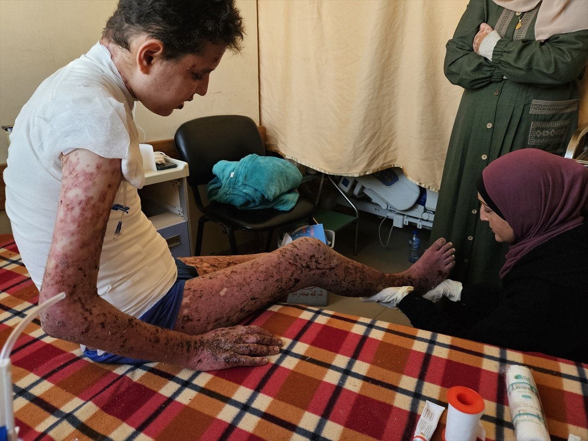 nadir cilt hastasi gazzeli cocuk saldirilar nedeni ile tedavi olamiyor 24