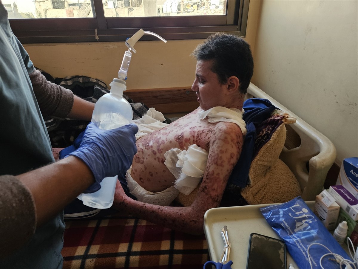 nadir cilt hastasi gazzeli cocuk saldirilar nedeni ile tedavi olamiyor 8 p96OKv53
